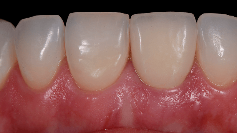 Procurando por Implante Dentário em Londrina? Saiba mais informações sobre a area de Implantodontia em Londrina. Temos mais de 30 anos de expertise, transformando sorrisos. Entre em contato agora mesmo