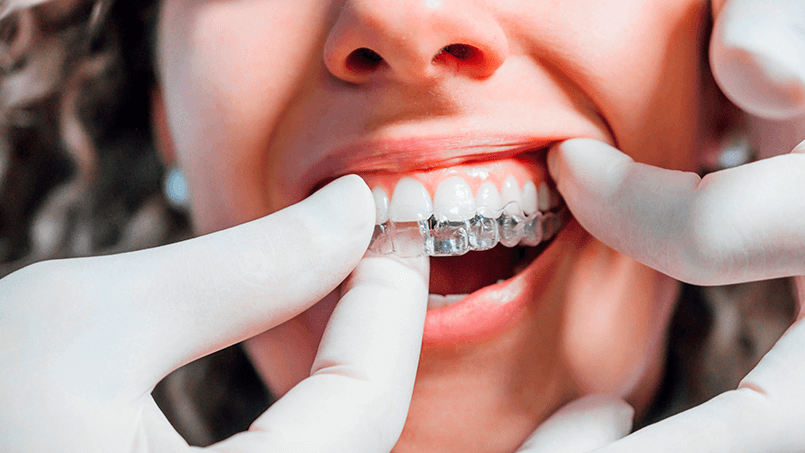 Invisalign em Londrina: Se você procura tratamento de ortodontia e aparelhos ortodônticos de qualidade, está no lugar certo. Com mais de 30 anos de expertise e os mais modernos aparelhos, proporcionamos um tratamento diferenciado e com a qualidade que seu sorriso merece.